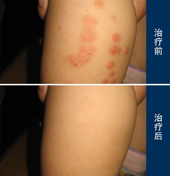 早期丘疹性荨麻疹的症状