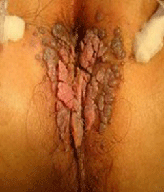 肛门周围皮肤结核的治疗方法有哪些