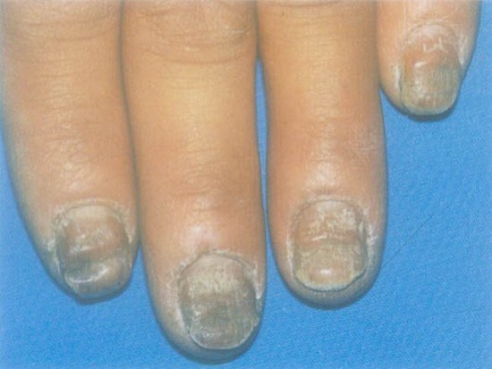 灰指甲的诊断方法有哪些