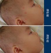 婴儿湿疹的特点及症状有哪些
