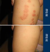 要分清楚小儿荨麻疹与小儿湿疹症状